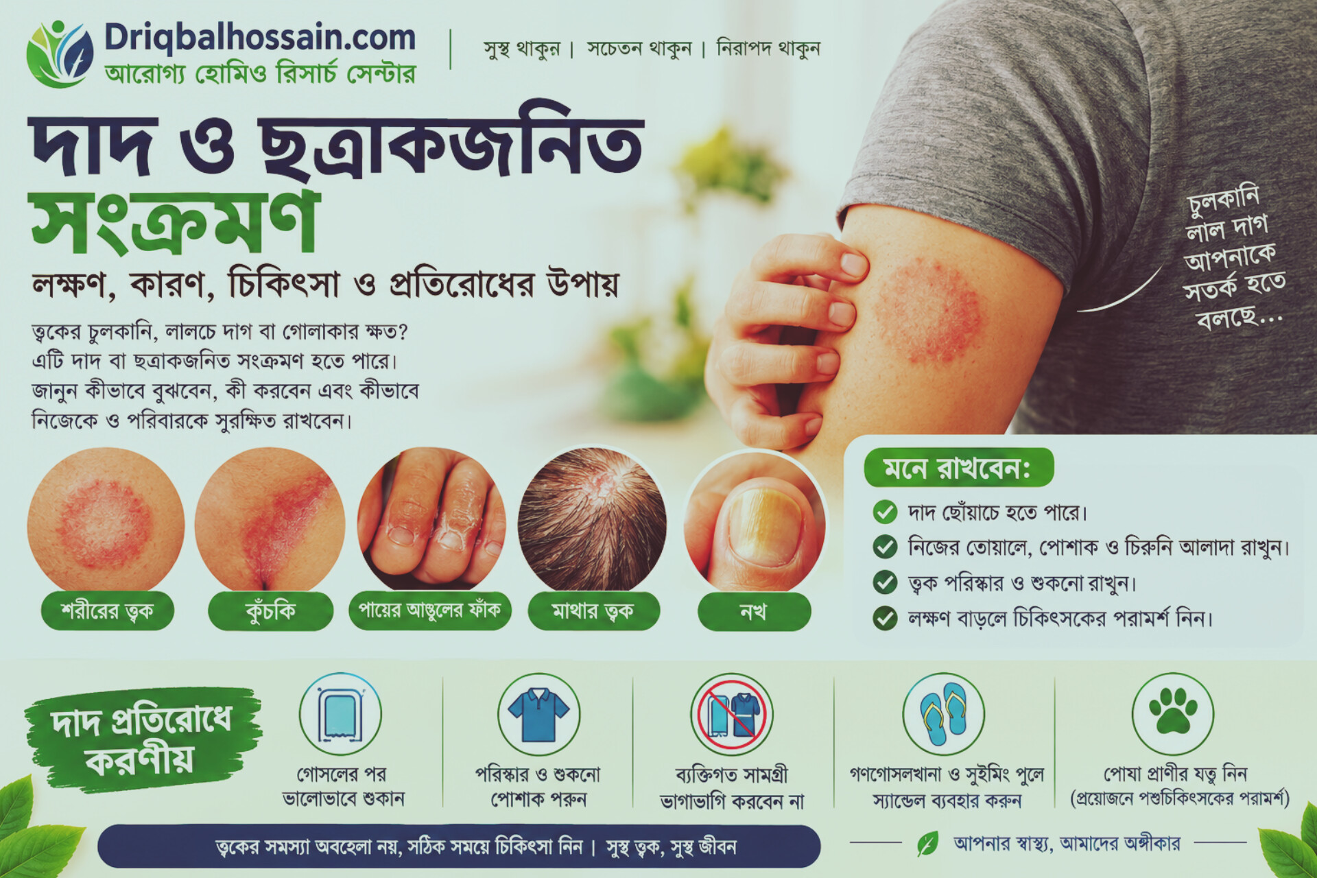 দাদ ও ছত্রাকজনিত সংক্রমণ: লক্ষণ, কারণ, চিকিৎসা ও প্রতিরোধের উপায়